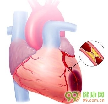 急救知识大全 心肌梗塞的急救方法