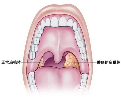 喉咙发炎怎么办 喉咙发炎吃什么好得快