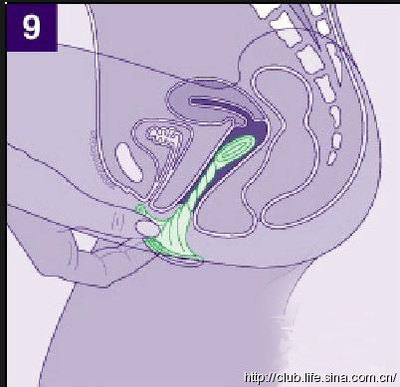 女用避孕套使用方法(图解） 女用避孕套的使用方法