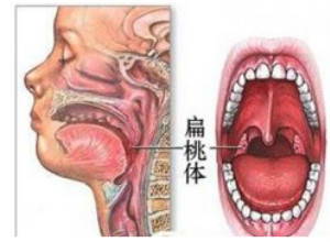 扁桃体发炎怎么办？ 小孩扁桃体发炎