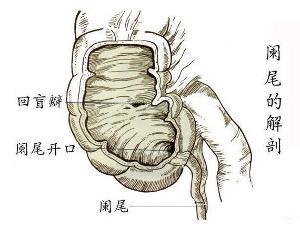 治疗慢性阑尾炎的方法 阑尾炎治疗要多少钱