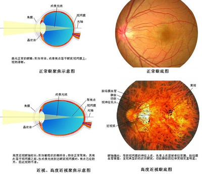 高度近视怎么治？ 高度近视的治疗