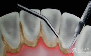 怎样去掉牙结石 去掉牙结石的方法