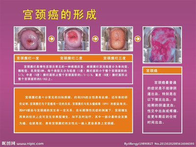 十几元钱就能治愈的＂宫颈糜烂＂验方 宫颈糜烂三度能治愈吗