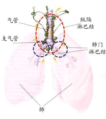 肺癌传染吗?肺癌晚期能传染吗? 肺癌会传染吗