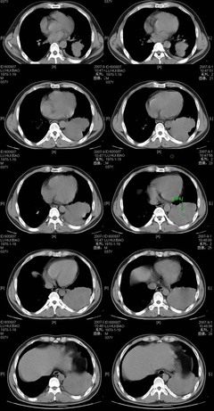 间皮瘤 [Mesothelioma] 胸膜间皮瘤能活多久