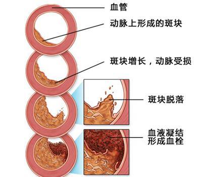 这3件事不做好，你的血管就会被它们一天天堵死