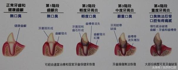 牙结石为什么那么臭？