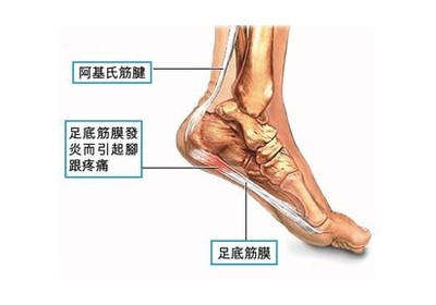 鸡眼的形成原因 详解鸡眼的治疗方法