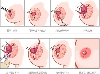 乳晕 乳晕-概述，乳晕-变黑原因