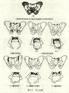 骨盆骨折 骨盆骨折-概述，骨盆骨折-原因