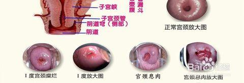 骨质增生的病因病理 宫颈增生 宫颈增生-病因与病理，宫颈增生-临床表现