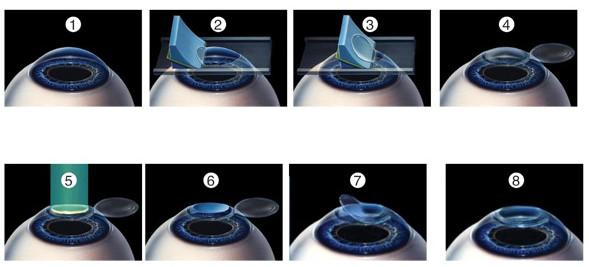 豆浆机工作原理简介 LASIK LASIK-简介，LASIK-原理