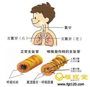 小儿支气管哮喘 小儿支气管哮喘-病因，小儿支气管哮喘-病机