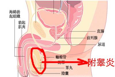 慢性附睾炎 慢性附睾炎-病因，慢性附睾炎-诊断