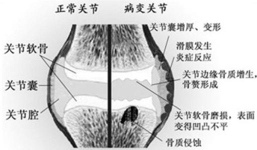 骨关节炎注意事项 下颚骨关节炎 下颚骨关节炎-简介，下颚骨关节炎-注意事项