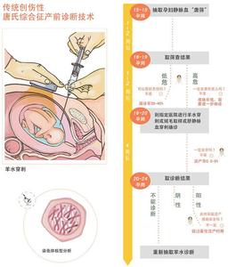 21三体综合症婴儿表现 21三体综合症 21三体综合症-病因，21三体综合症-临床表现