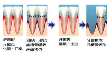 牙龈出血 牙龈出血-发病原因，牙龈出血-病因