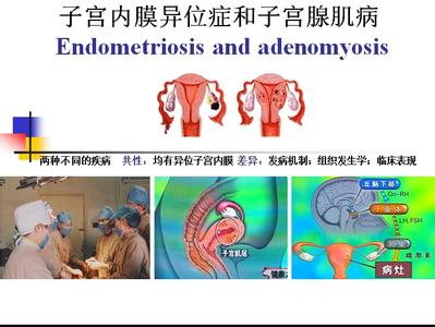 子宫内膜结核 子宫内膜结核-概述，子宫内膜结核-发病原因