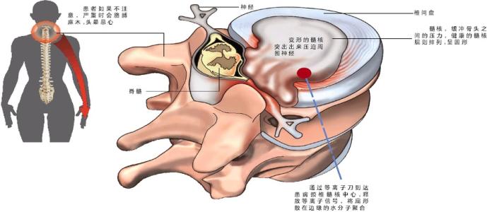 椎动脉型颈椎病 椎动脉型颈椎病-临床症状分类，椎动脉型颈椎病-