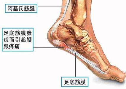 跟骨痛 跟骨痛-足跟痛概述，跟骨痛-疾病的病因