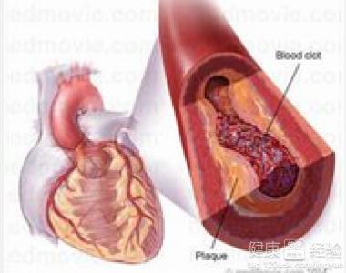 冠状动脉粥样硬化 冠状动脉粥样硬化-疾病概述，冠状动脉粥样硬化