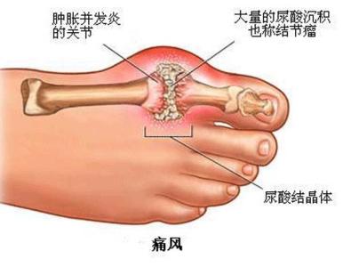 痛风 痛风-病因，痛风-分类