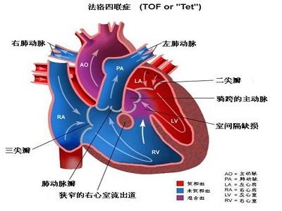 热衰竭的发病机理是 法乐氏四联症 法乐氏四联症-疾病概述，法乐氏四联症-发病机理