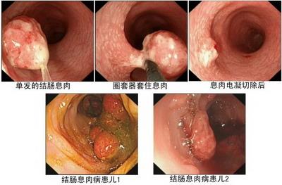 直肠息肉 直肠息肉-概述，直肠息肉-病因