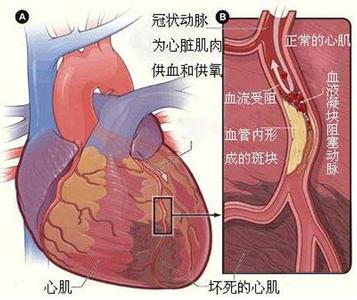 心梗 心梗-概述，心梗-前兆