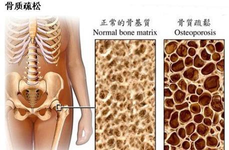 骨质疏松 骨质疏松-简介，骨质疏松-病因分类
