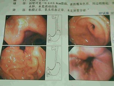 脑出血病因及发病机制 胃溃疡出血 胃溃疡出血-病因，胃溃疡出血-发病机制