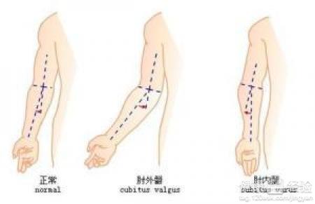 肘内翻 肘内翻 肘内翻-简介，肘内翻-【发病机理】