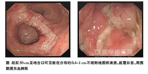 成人T细胞淋巴瘤 成人T细胞淋巴瘤-症状体征，成人T细胞淋巴瘤-病