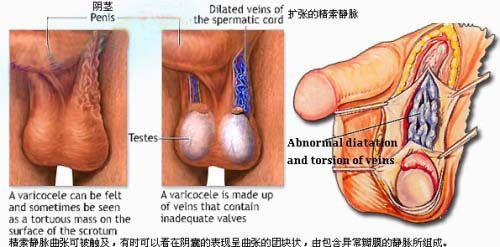 精索静脉曲张的症状 精索静脉曲张症状危害专家具体介绍