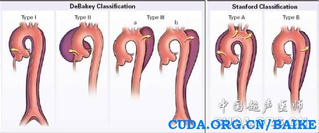 胸主动脉夹层动脉瘤 胸主动脉夹层动脉瘤-临床表现，胸主动脉夹层