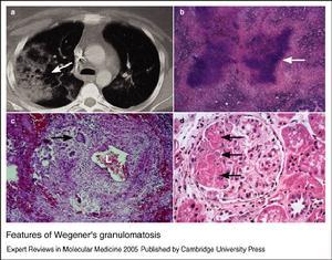 韦格纳肉芽肿 韦格纳肉芽肿 韦格纳肉芽肿-简介，韦格纳肉芽肿-病因和发病机制