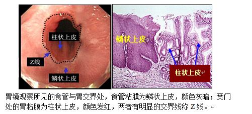 Barrett食管 Barrett食管-病因，Barrett食管-临床表现