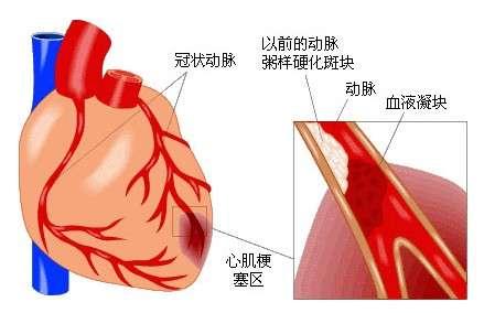 糖尿病病因和发病机制 腱病 腱病-病因，腱病-发病机制