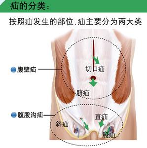 小肠气 小肠气-病因，小肠气-分类