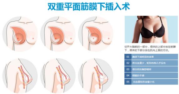 假体隆胸手术费用 假体隆胸手术 假体隆胸手术-发展史，假体隆胸手术-简介