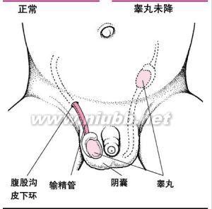 隐睾症 隐睾症 隐睾症-简介，隐睾症-发病率