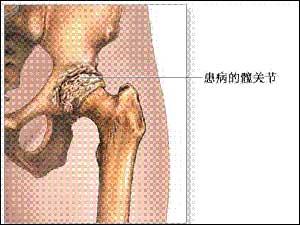 急性脊髓炎的临床表现 急性脊髓炎 急性脊髓炎-病理，急性脊髓炎-临床表现