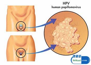 尖锐湿疣 尖锐湿疣-症状，尖锐湿疣-治疗