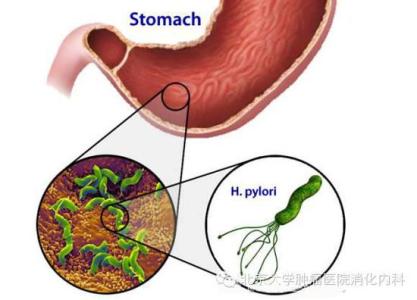 幽门螺杆菌传染婴儿吗 幽门螺杆菌传染吗？