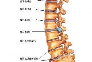 包皮过长诱发性疾病 腰间盘突出 腰间盘突出-概述，腰间盘突出-疾病诱发