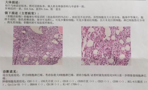 t细胞淋巴瘤 发病率 弥漫大B细胞淋巴瘤 弥漫大B细胞淋巴瘤-发病率，弥漫大B细胞淋巴