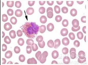 嗜酸性粒细胞的作用 嗜酸性粒细胞 嗜酸性粒细胞-形态，嗜酸性粒细胞-作用