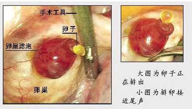 卵泡黄素化 卵泡黄素化 卵泡黄素化-特点，卵泡黄素化-发生率