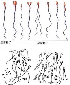 精神疾病临床症状 畸形精子 畸形精子-临床症状，畸形精子-疾病检查